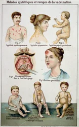 Tafel, die die verschiedenen Formen syphilitischer Krankheiten und die Gefahren der Impfung illustriert - in Bilz Naturheilkunde, Ende des 19. Jahrhunderts