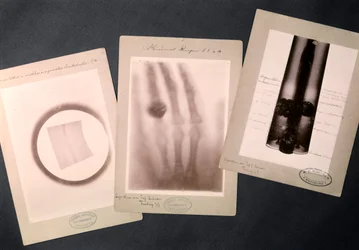 Originale Radiographien von Röntgen