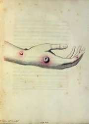 Kuhpockenpustel am Arm von Sarah Nelmes, aus 